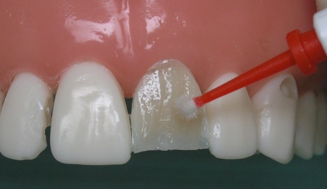 Адгезивні системи в стоматології: що це таке, види, застосування - фото3