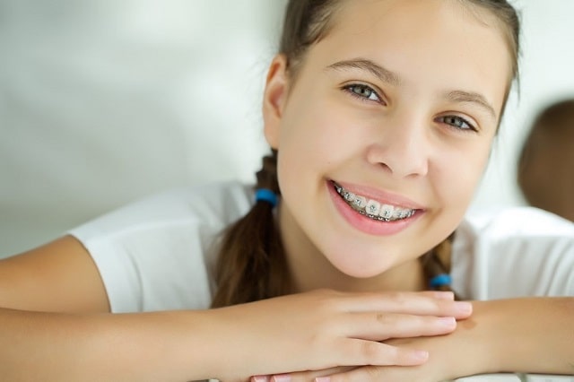 Брекеты: виды, отличия, какие лучше выбрать - фото4 Брекеты: виды, отличия, какие лучше выбрать - фото4