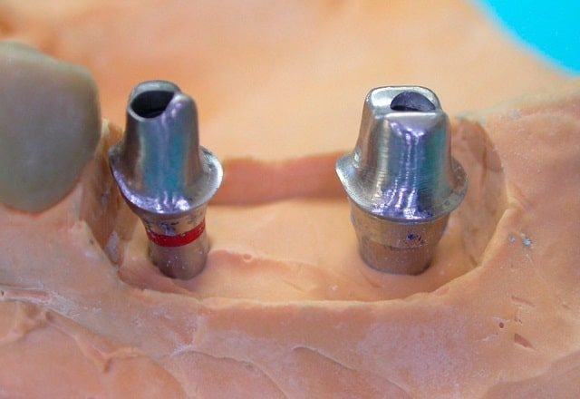 Что такое абатменты и почему они так важны в имплантологии зубов - фото2