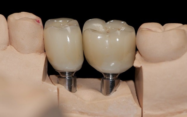 Что такое абатменты и почему они так важны в имплантологии зубов - фото4