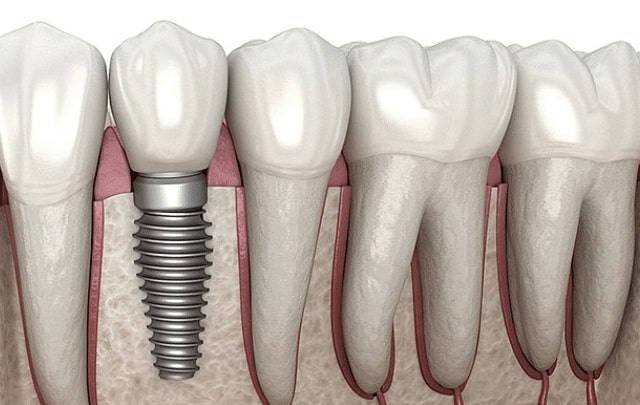 Етапи установки зубних імплантів - фото1