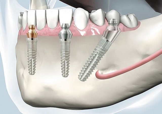 Имплантация зубов: что это такое, как происходит, плюсы и минусы - фото4