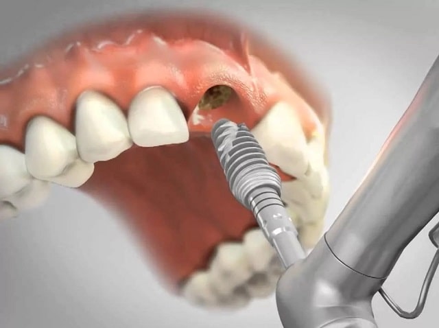 Имплантация зубов: что это такое, как происходит, плюсы и минусы - фото5