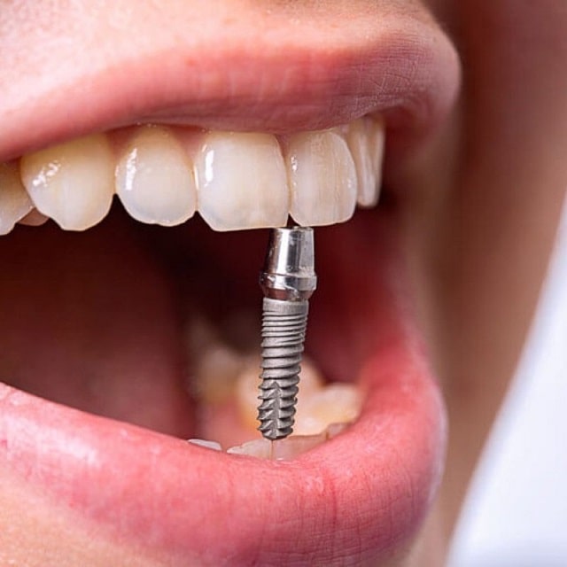 Имплантация зубов: что это такое, как проходит, этапы - фото3