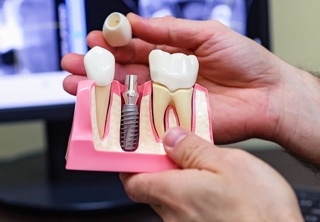 Имплантация зубов: что это такое, как проходит, этапы - фото5