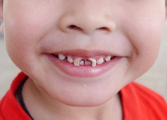 Кариес у детей: причины, симптомы, профилактика - фото1 Кариес у детей: причины, симптомы, профилактика - фото1