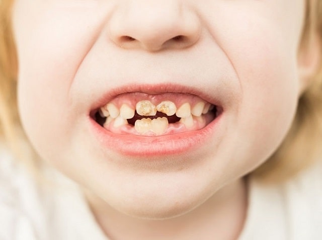 Кариес у детей: причины, симптомы, профилактика - фото2 Кариес у детей: причины, симптомы, профилактика - фото2