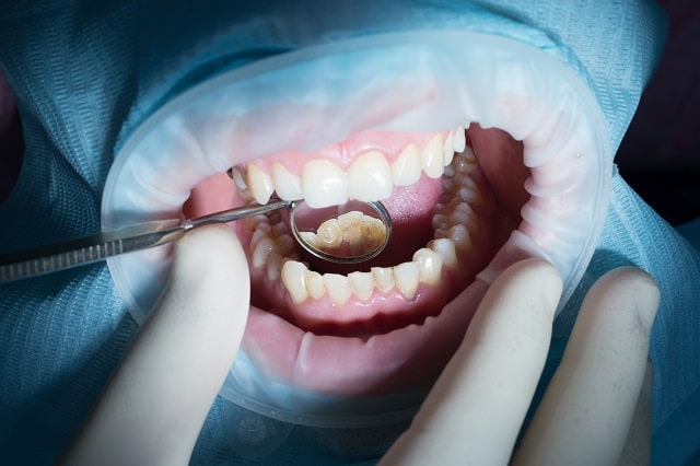 Кариес зубов: причины возникновения, профилактика и лечение у взрослых - фото1 Кариес зубов: причины возникновения, профилактика и лечение у взрослых - фото1