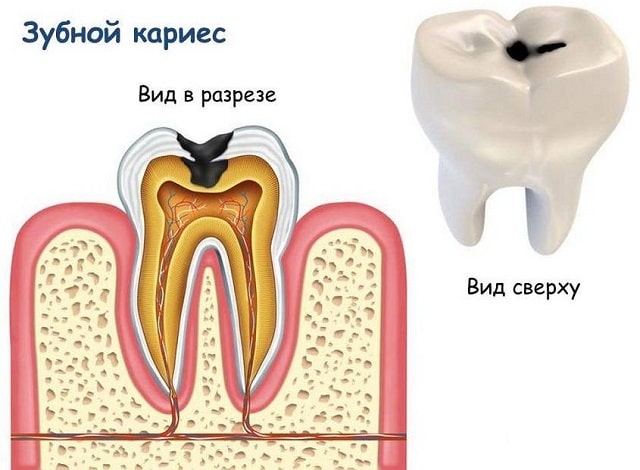 Кариес зубов: причины возникновения, профилактика и лечение у взрослых - фото2 Кариес зубов: причины возникновения, профилактика и лечение у взрослых - фото2