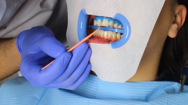 Отбеливание зубов Beyond: что это такое, плюсы и минусы - фото1 Отбеливание зубов Beyond: что это такое, плюсы и минусы - фото1