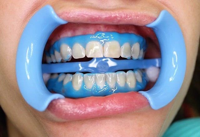 Отбеливание зубов: виды, особенности, плюсы и минусы - Химическое отбеливание