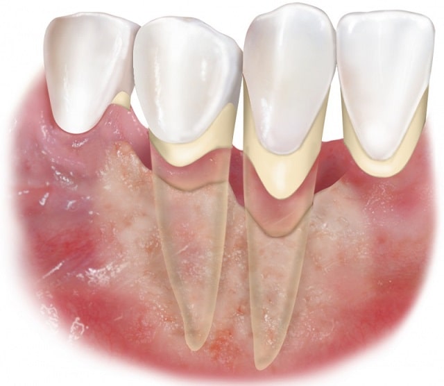 Пародонтоз: что это такое, причины, симптомы, профилактика - фото1