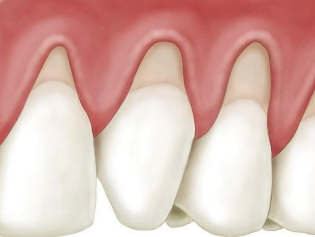 Пародонтоз: что это такое, причины, симптомы, профилактика - фото2