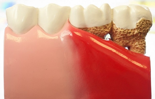 Пародонтоз: что это такое, причины, симптомы, профилактика - фото4