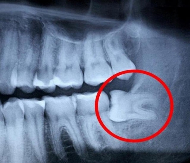 Ретенция зуба: что такое, причины и последствия - фото3 Ретенция зуба: что такое, причины и последствия - фото3