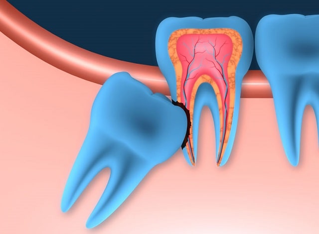 Ретенция зуба: что такое, причины и последствия - фото4 Ретенция зуба: что такое, причины и последствия - фото4
