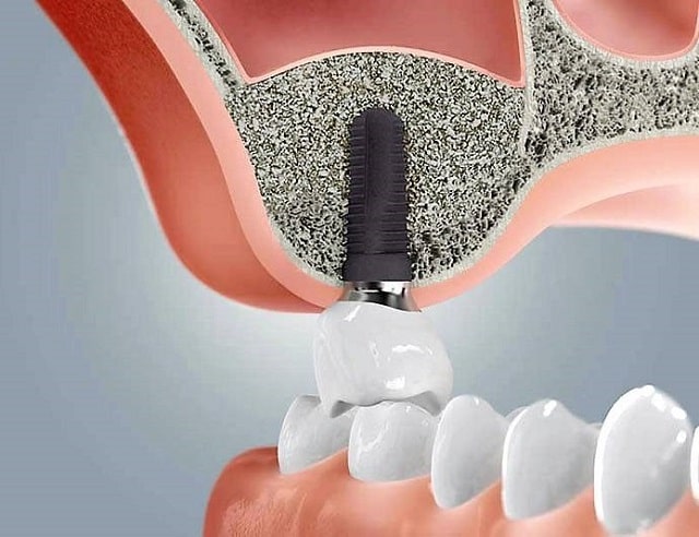 Синус-лифтинг: что это такое, виды, как и когда проводится - фото1