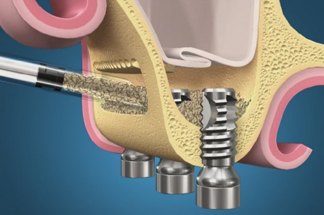 Синус-лифтинг: что это такое, виды, как и когда проводится - фото2