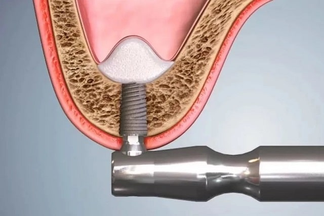 Синус-лифтинг: что это такое, виды, как и когда проводится - фото3