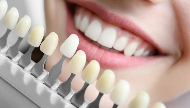 Виниры для зубов: что это такое, какие бывают, плюсы и минусы - фото1