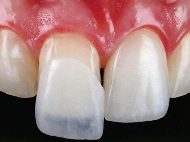 Виниры для зубов: что это такое, какие бывают, плюсы и минусы - фото4
