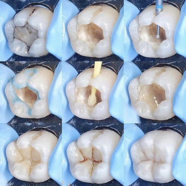Зубные пломбы: виды и особенности, какая лучше - фото2 Зубные пломбы: виды и особенности, какая лучше - фото2
