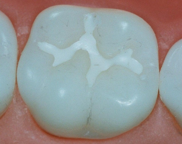 Зубные пломбы: виды и особенности, какая лучше - фото3 Зубные пломбы: виды и особенности, какая лучше - фото3
