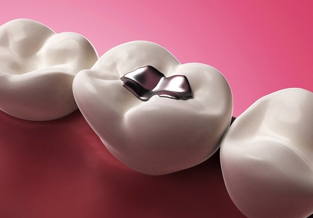 Зубные пломбы: виды и материалы, какие лучше - фото4