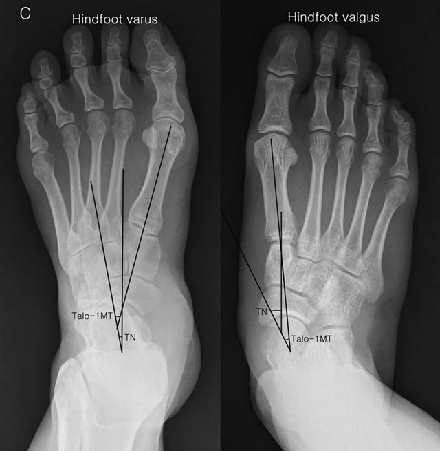 Вальгусная и варусная деформация стопы: что это такое, в чем разница, причины - фото1