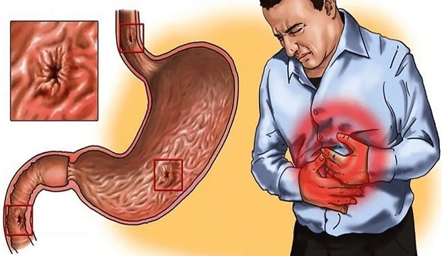 Что такое гастрит: виды, симптомы, профилактика - фото2 Что такое гастрит: виды, симптомы, профилактика - фото2