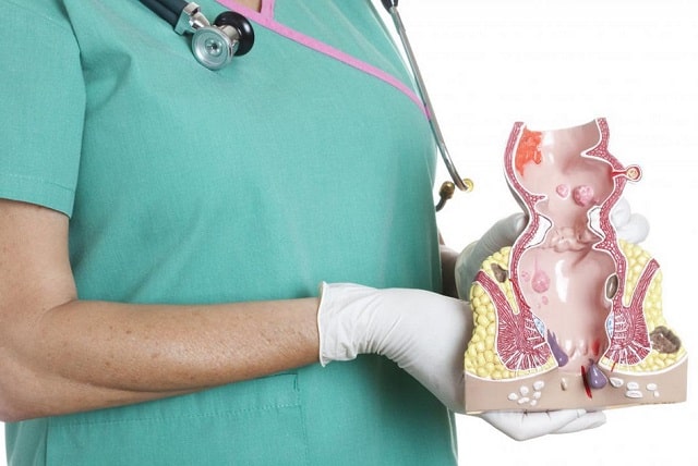 Геморрой: что это такое, симптомы, причины возникновения и профилактика - фото2 Геморрой: что это такое, симптомы, причины возникновения и профилактика - фото2