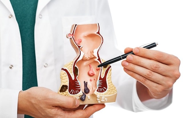 Геморрой: что это такое, симптомы, причины возникновения и профилактика - фото3 Геморрой: что это такое, симптомы, причины возникновения и профилактика - фото3