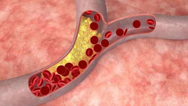 Гиперлипидемия: что это такое, причины, симптомы, профилактика - фото3