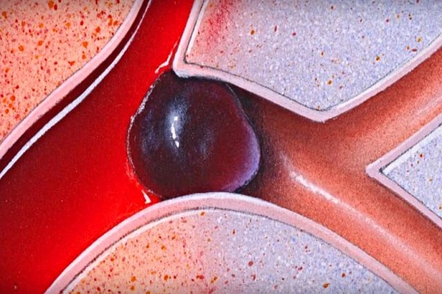 Густая кровь: что это значит, причины, симптомы, профилактика - фото1 Густая кровь: что это значит, причины, симптомы, профилактика - фото1