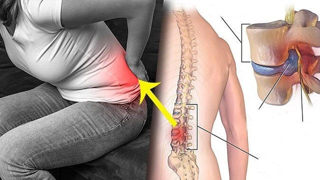 Межпозвоночная грыжа: что это такое, симптомы, профилактика - фото1