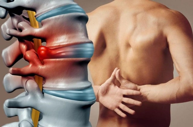 Межпозвоночная грыжа: что это такое, симптомы, профилактика - фото2