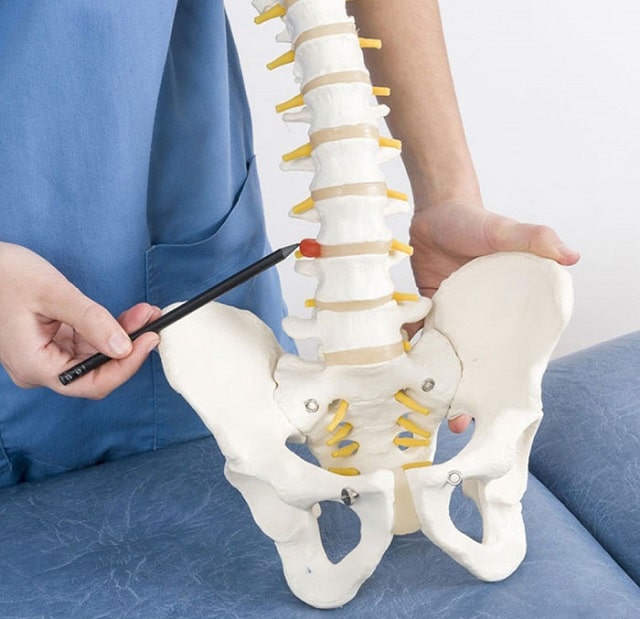 Межпозвоночная грыжа: что это такое, симптомы, профилактика - фото3