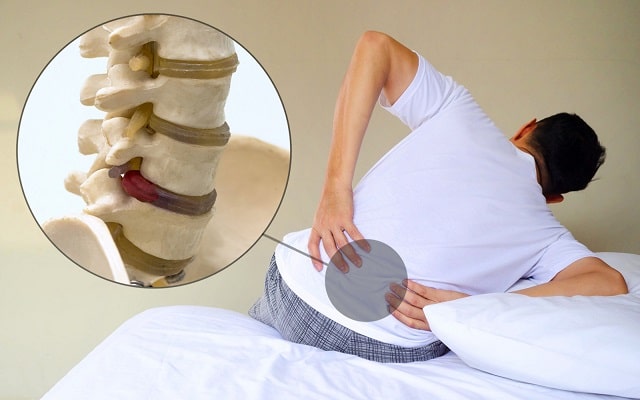 Межпозвоночная грыжа: что это такое, симптомы, профилактика - фото4