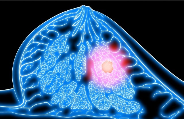 Рак груди у женщин: стадии, симптомы, как распознать - фото2