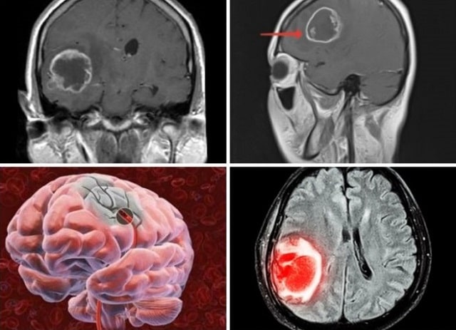 Рак мозга: симптомы, первые признаки, стадии - фото2