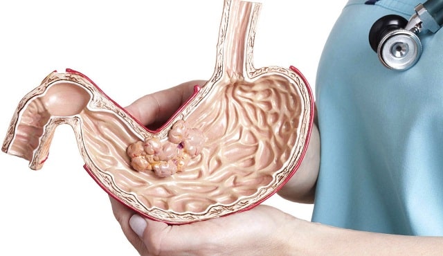 Рак желудка: симптомы, первые признаки, профилактика - фото1 Рак желудка: симптомы, первые признаки, профилактика - фото1