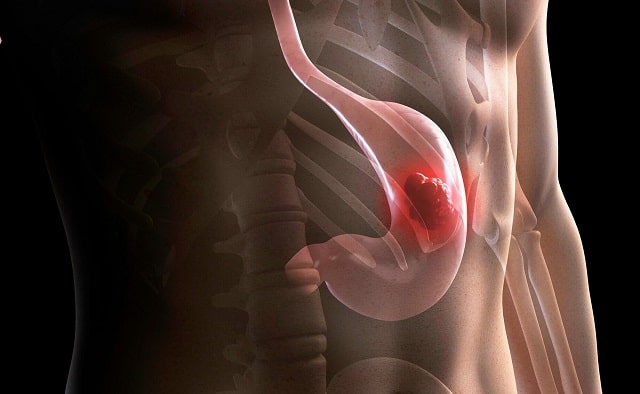 Рак желудка: симптомы, первые признаки, профилактика - фото2 Рак желудка: симптомы, первые признаки, профилактика - фото2