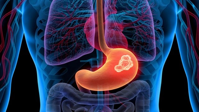 Рак желудка: симптомы, первые признаки, профилактика - фото4 Рак желудка: симптомы, первые признаки, профилактика - фото4