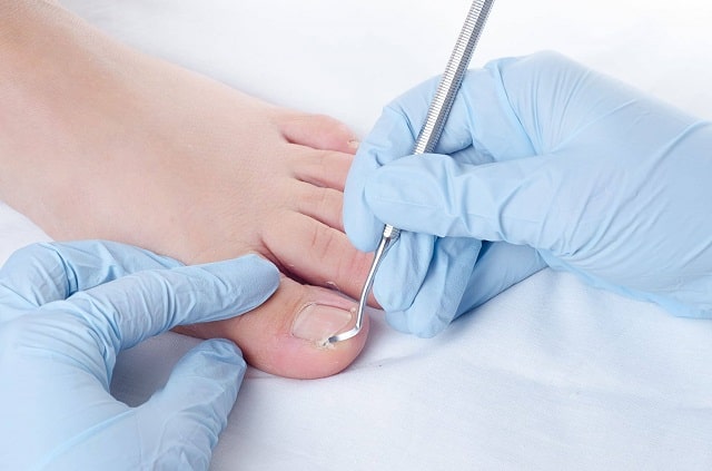 Вросший ноготь: причины появления, что делать, профилактика - фото1