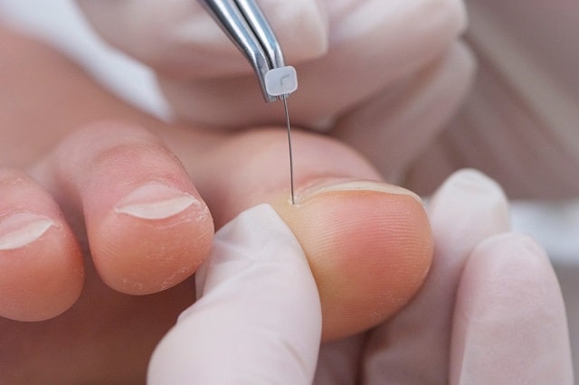 Вросший ноготь: причины появления, что делать, профилактика - фото2