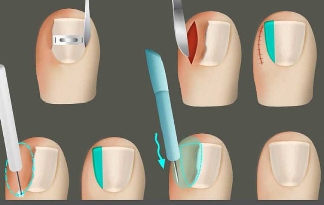 Вросший ноготь: причины появления, что делать, профилактика - фото4