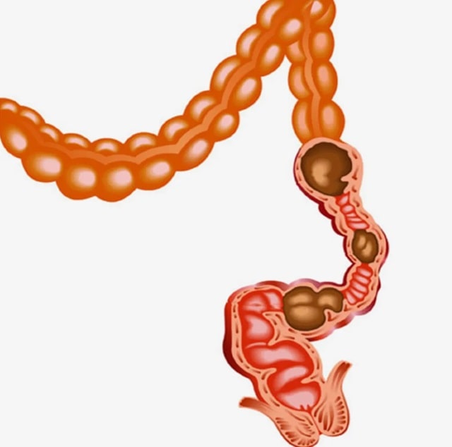 Запор: что это такое, причины, профилактика - фото2