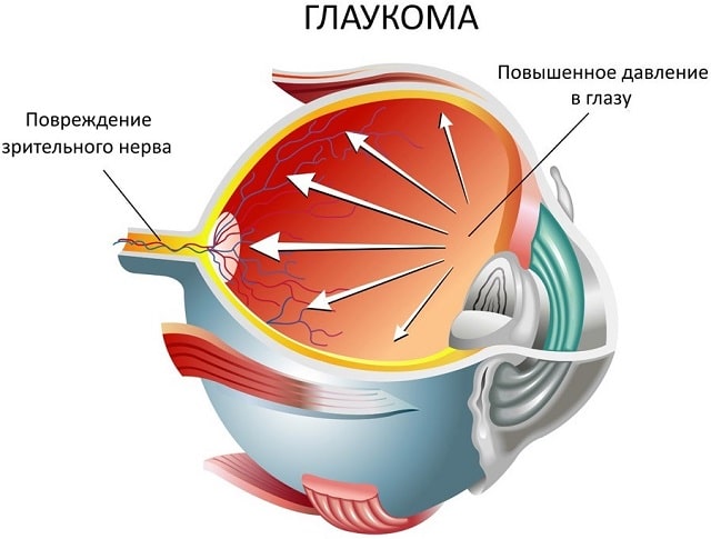 Как проявляется глаукома: симптомы и лечение - фото2 Как проявляется глаукома: симптомы и лечение - фото2