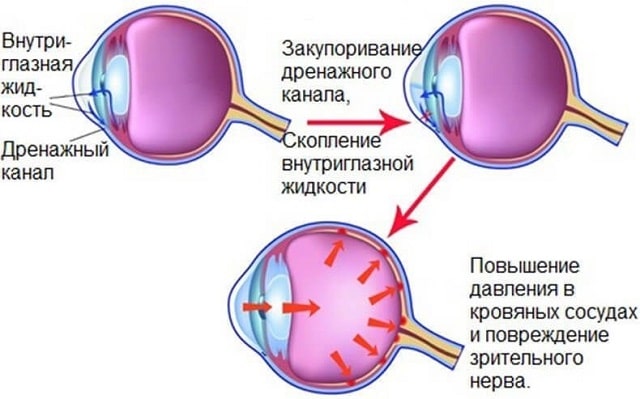 Как проявляется глаукома: симптомы и лечение - фото3 Как проявляется глаукома: симптомы и лечение - фото3
