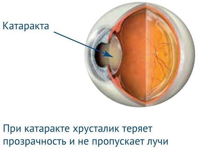 Катаракта: что это за болезнь, симптомы и причины - фото1